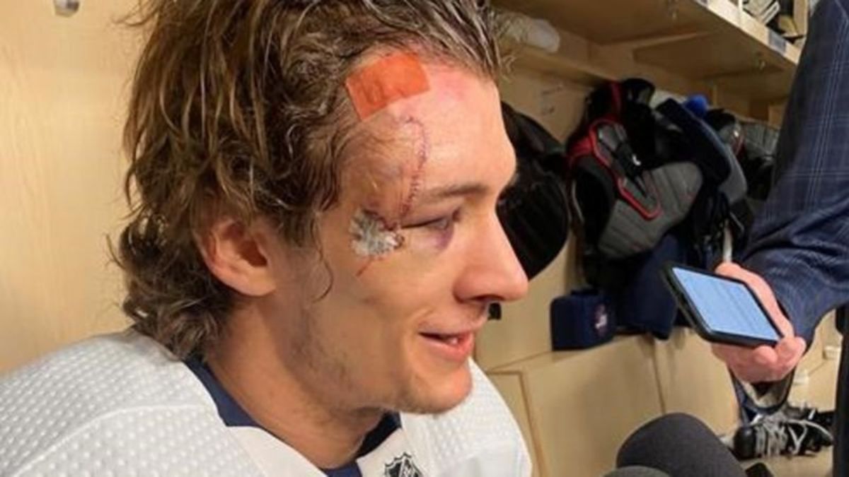 Morgan Barron takes 75 stitches to the face
