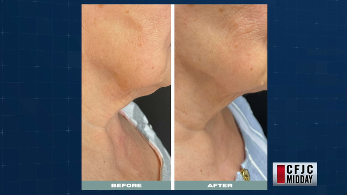 CFJC Midday Skin tightening, photofacial, tribella and body